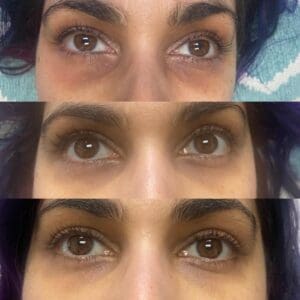 RF Microneedling Toronto