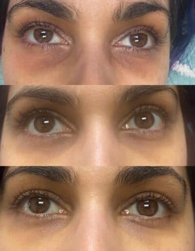 RF Microneedling Toronto