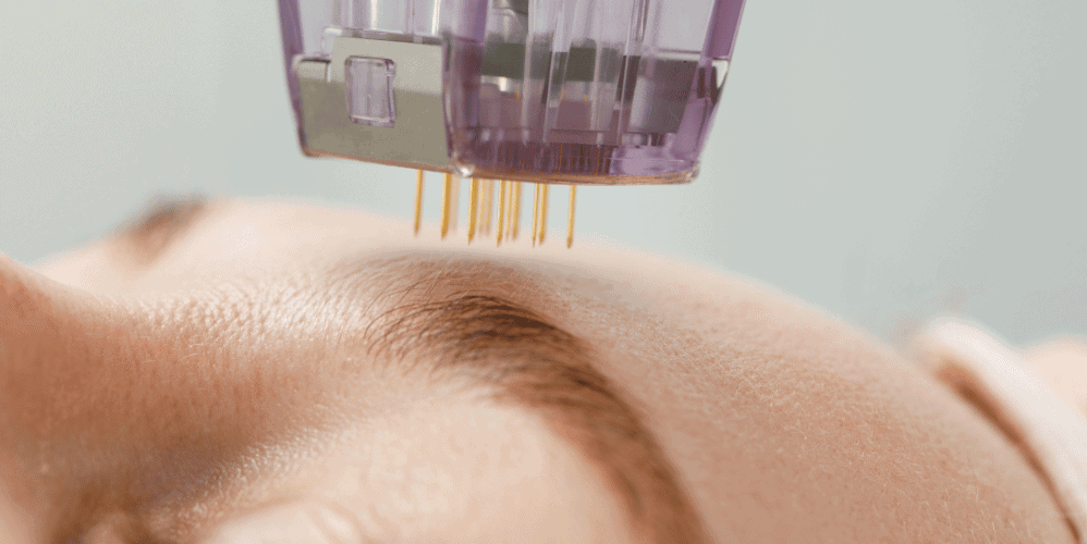 How Much Does Microneedling Cost in Toronto