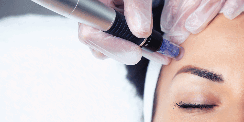 How much does RF Microneedling cost in Toronto