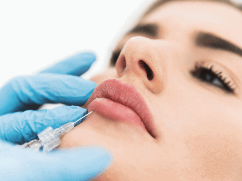 Hyaluronic Acid Lip Fillers Etobicoke Hyaluronic Acid Lip Fillers Etobicoke