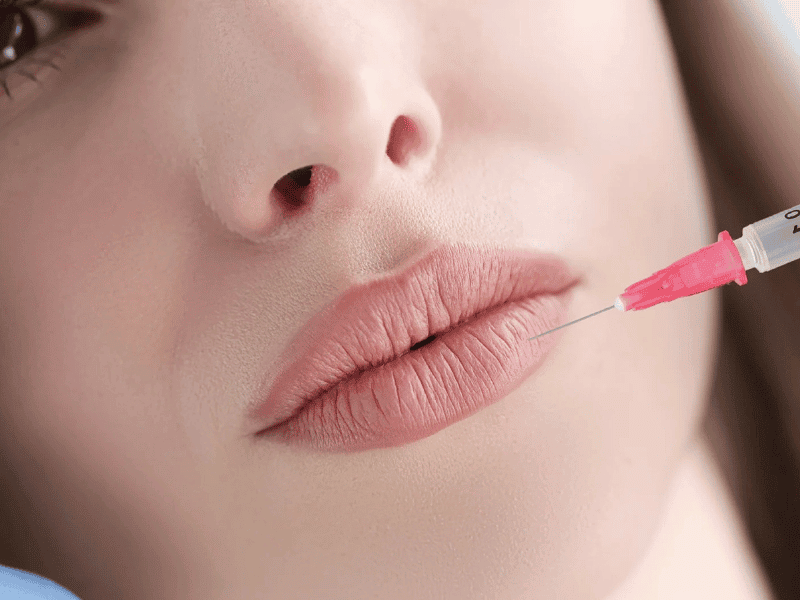 Lip Augmentation and Reshaping with Dermal Fillers Etobicoke(1) Lip Augmentation and Reshaping with Dermal Fillers Etobicoke(1)