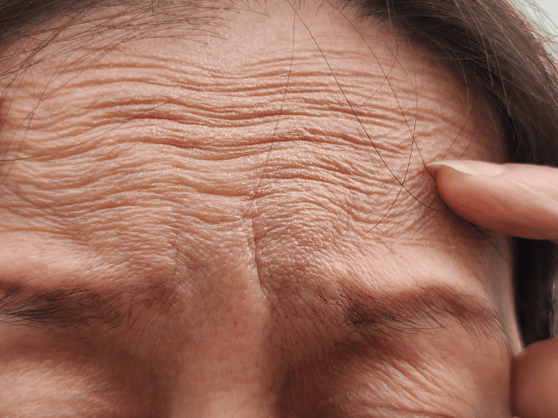 RF Microneedling for Wrinkles and Fine Lines in Etobicoke