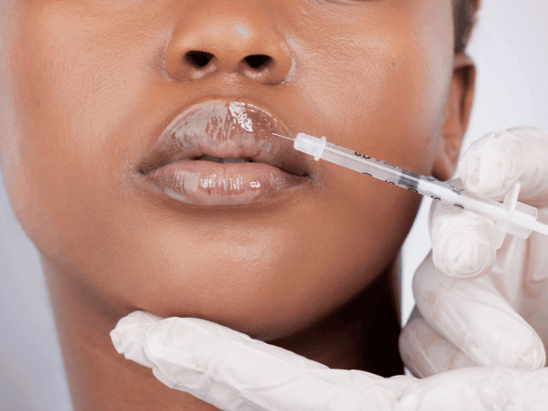 Restoring Lip Volume with Collagen Lip Injections in Etobicoke Restoring Lip Volume with Collagen Lip Injections in Etobicoke