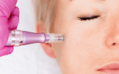 Is Microneedling Really Worth It? Microneedling Benefits & Uses